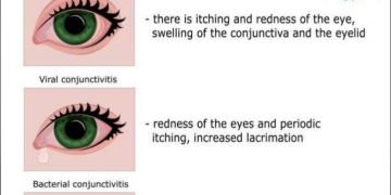 Pink Eye in Kids: Causes, Symptoms, and Effective Management