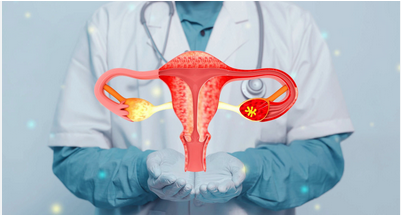 Endometriosis Unveiled: Shedding Light on a Common Women’s Health Condition