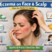 How to Deal with Eczema on Face and Scalp: Important Tips to Cope Safely