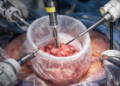 The Role of Morcellation Bags in Minimally Invasive Surgery