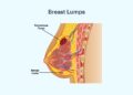Why Is Lump Made in Breast?