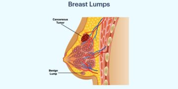 Why Is Lump Made in Breast?