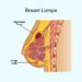 Why Is Lump Made in Breast?