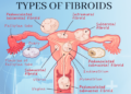 Fibroids in Women: Why They Happen and What You Should Know