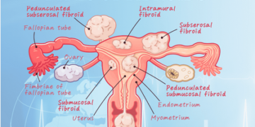 Fibroids in Women: Why They Happen and What You Should Know