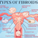 Fibroids in Women: Why They Happen and What You Should Know