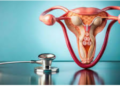 Endometriosis Unveiled: Shedding Light on a Common Women’s Health Condition