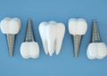 Top Reasons to Choose Dental Implants