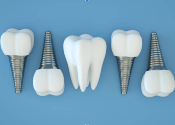 Top Reasons to Choose Dental Implants