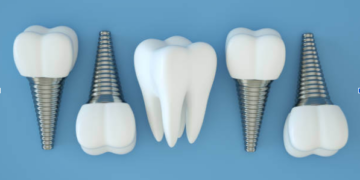 Top Reasons to Choose Dental Implants