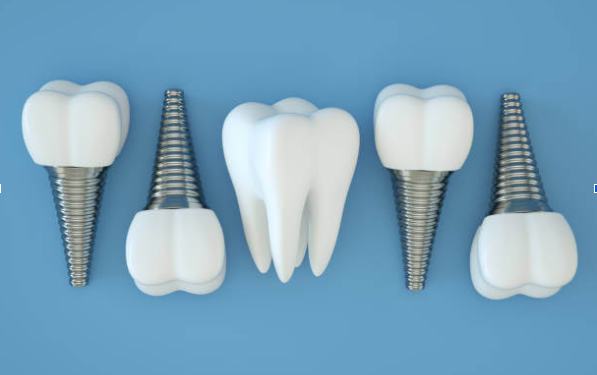 Top Reasons to Choose Dental Implants