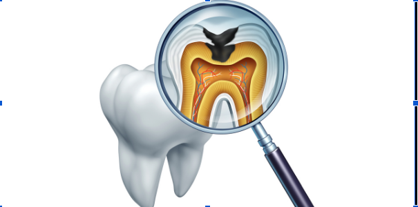 How Long Does a Root Canal Take? A Complete Guide
